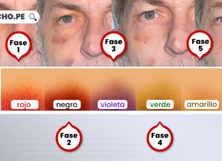 Evolucion equimosis-LP